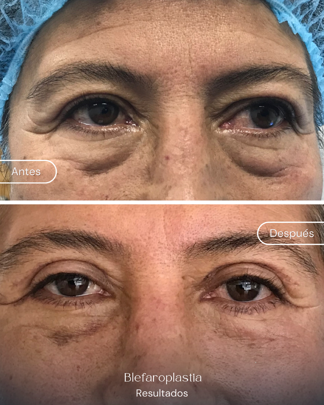 Blefaroplastia (5)