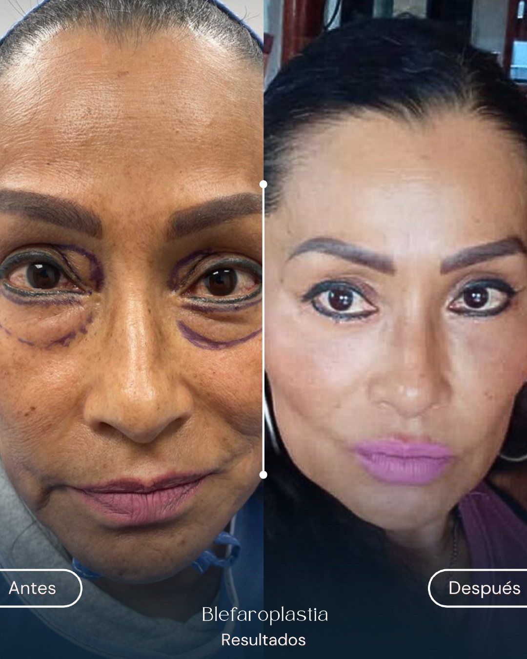 Blefaroplastia