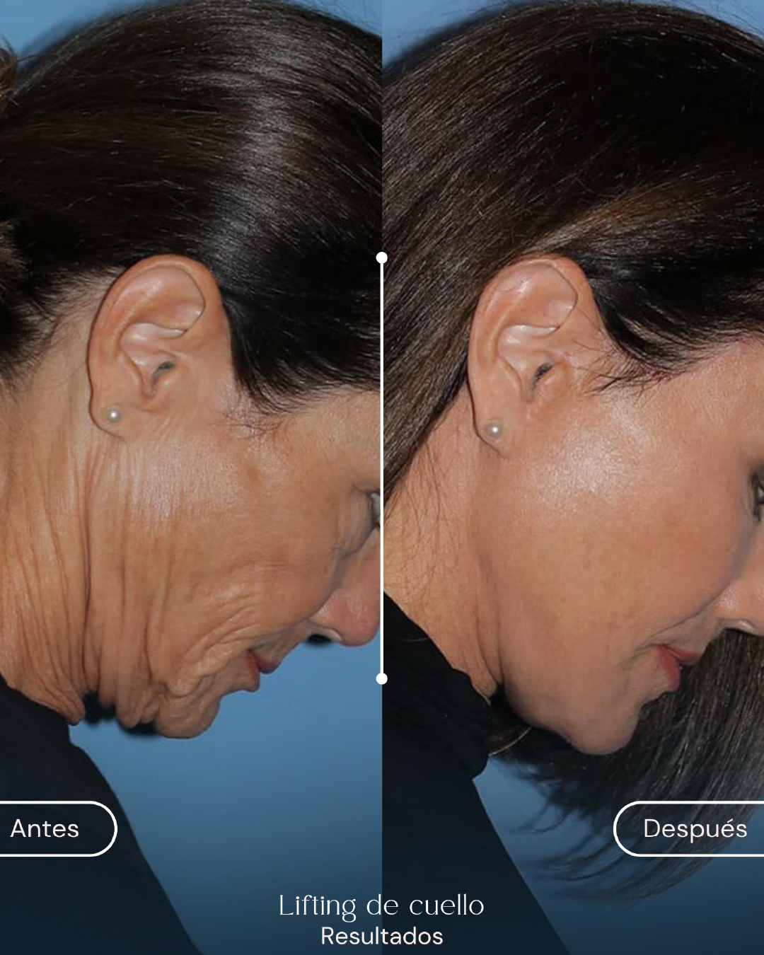 Lifting de cuello (1)