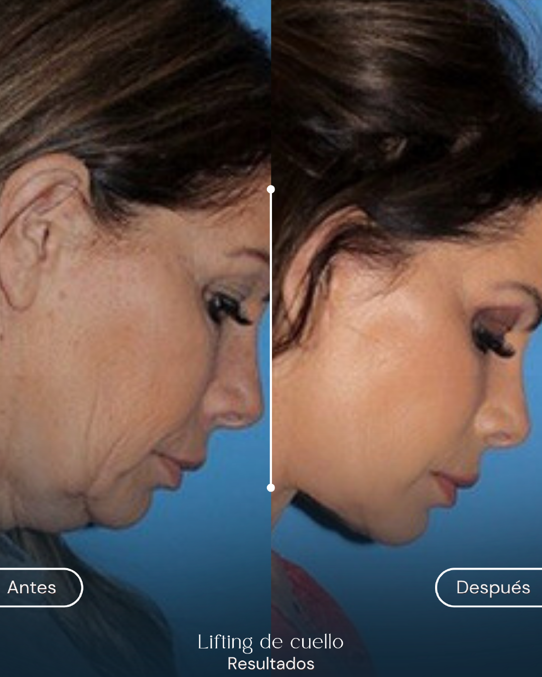 Lifting de cuello (2)