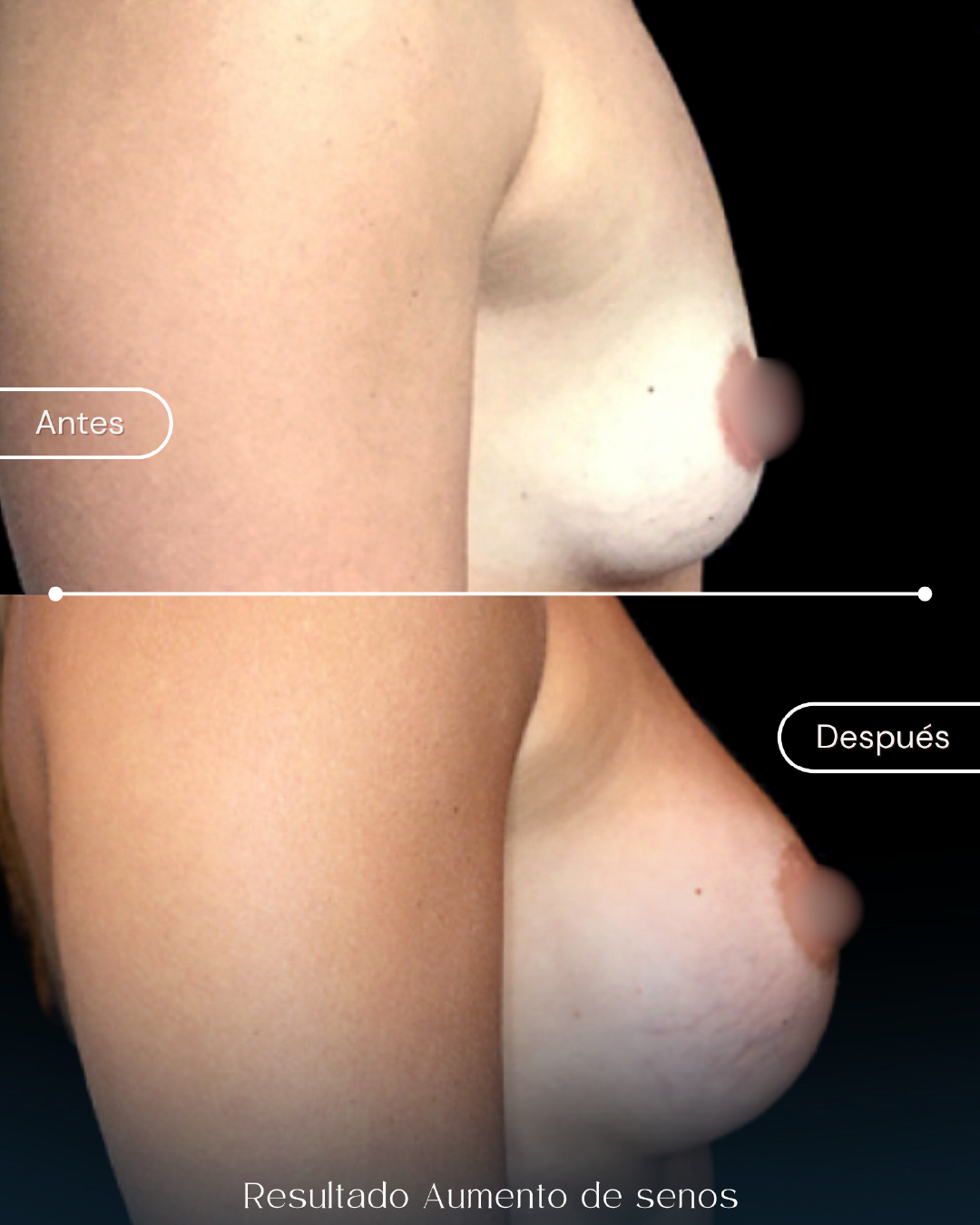mamoplastia (1)