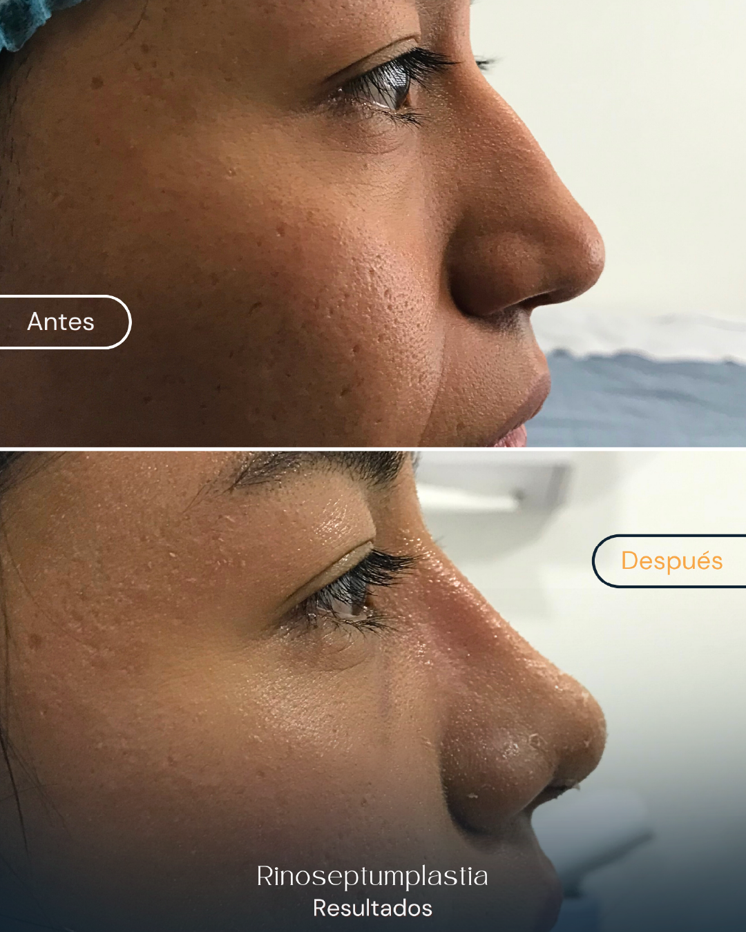 rinoseptumplastia (1)