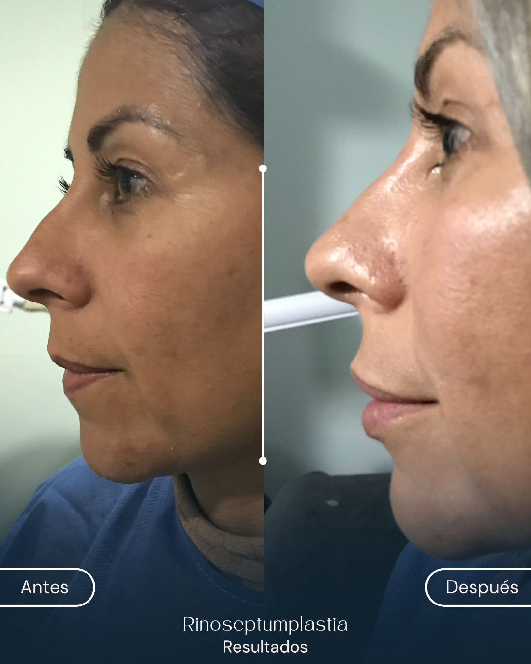 rinoseptumplastia (2)